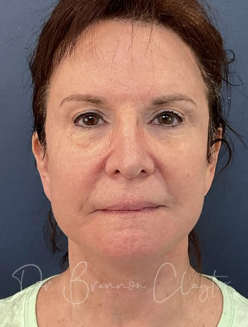 deep-plane-facelift-35820a-after-cnplastics