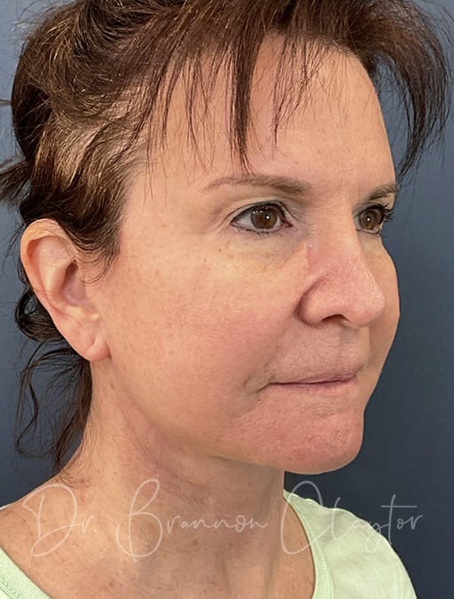 deep-plane-facelift-35820b-after-cnplastics