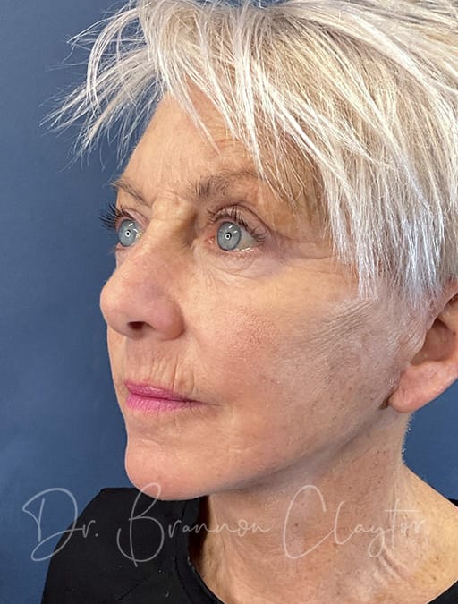 deep-plane-facelift-blepharoplasty-53659b-after-cnplastics