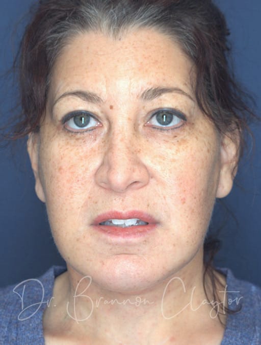 deep-plane-facelift-c-necklift-53872a-after-cnplastics