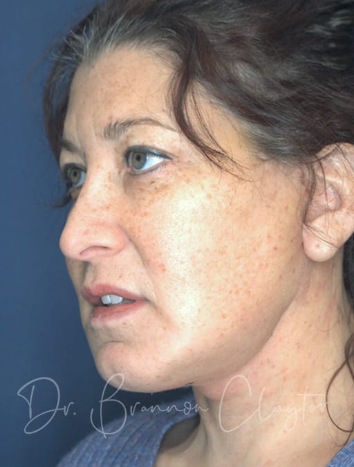 Deep Plane Facelift & C Neck Lift