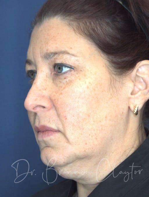 Deep Plane Facelift & C Neck Lift