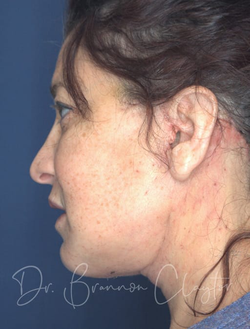 deep-plane-facelift-c-necklift-53872c-after-cnplastics