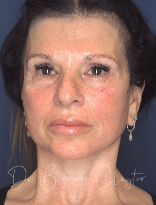 deep-plane-facelift-neck-lift-eyes-53538a-after-cnplastics