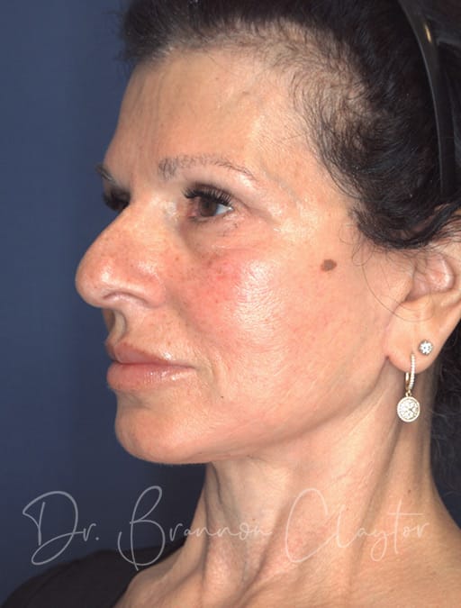 deep-plane-facelift-neck-lift-eyes-53538b-after-cnplastics