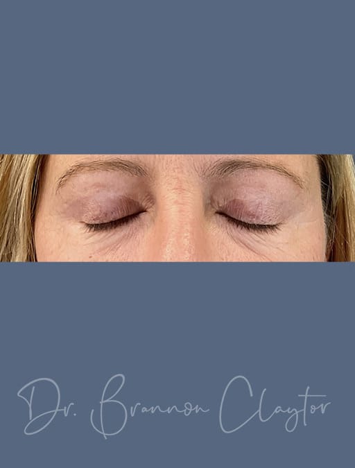 eyelids-51885-after-a2-cnplastics