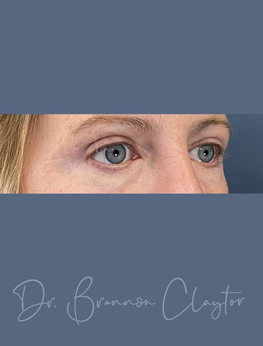 eyelids-51885-after-b-cnplastics