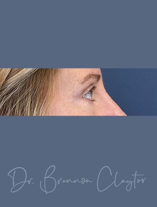 Upper Blepharoplasty