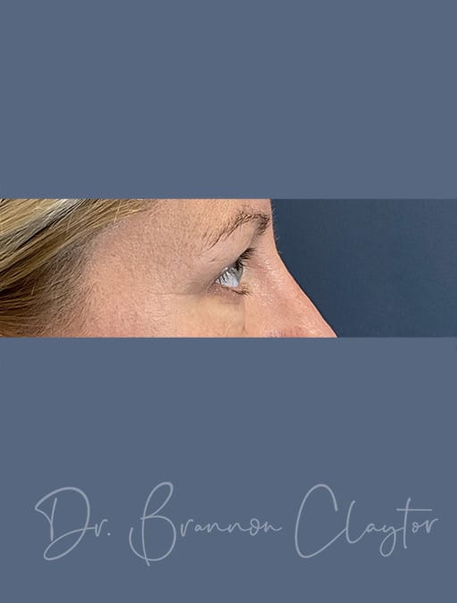 Upper Blepharoplasty