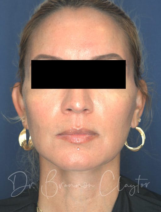facelift-53169-a-after-cnplastics