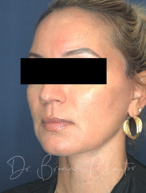 facelift-53169-b-after-cnplastics