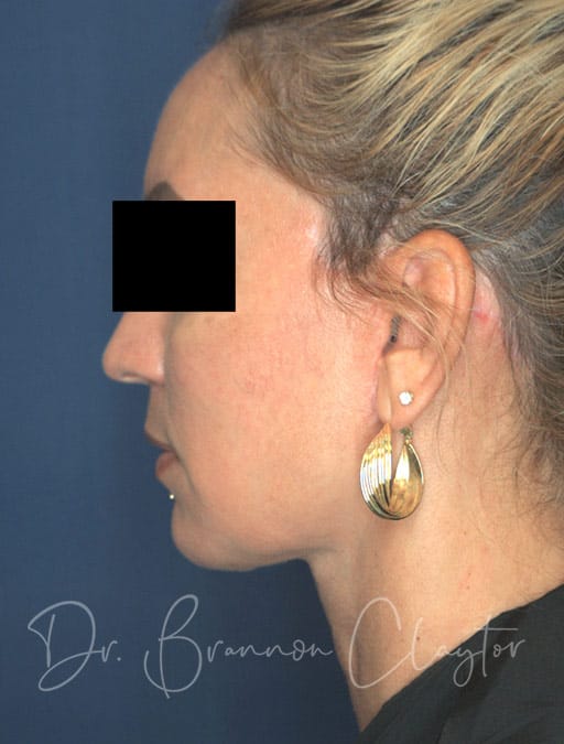 Deep Plane Facelift