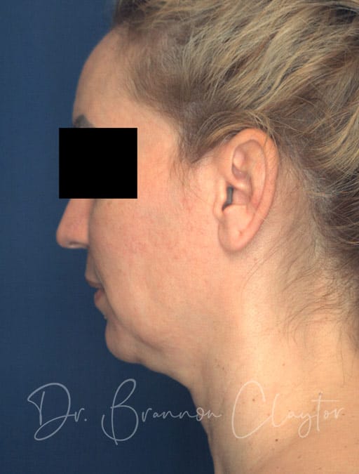 Deep Plane Facelift