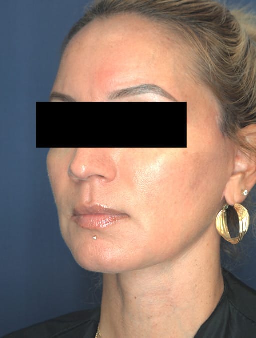 facelift-53169b-after-cnplastics