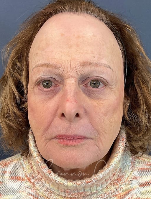 facial-rejuvenation-LaMiNa-35344a-after-cnplastics