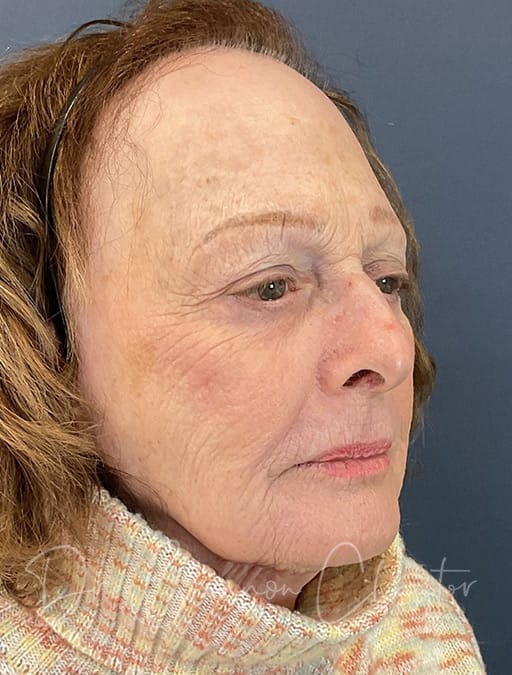 facial-rejuvenation-LaMiNa-35344b-after-cnplastics