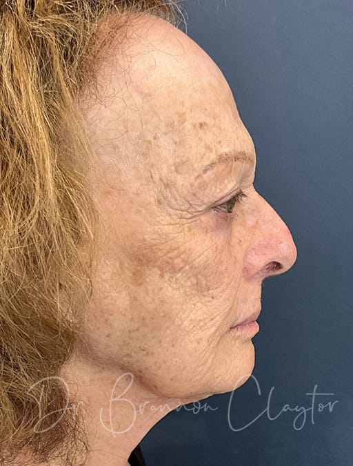 Facial Rejuvenation LaMiNa