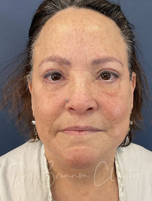 neck-lift-eyes-fat-injections-53542a-after-cnplastics