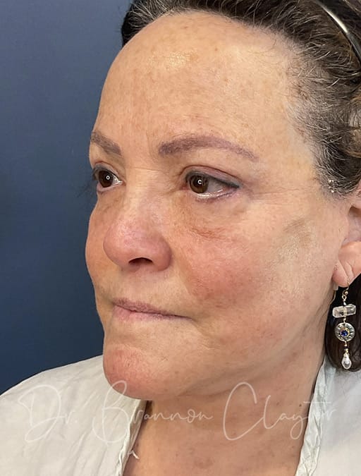 neck-lift-eyes-fat-injections-53542b-after-cnplastics
