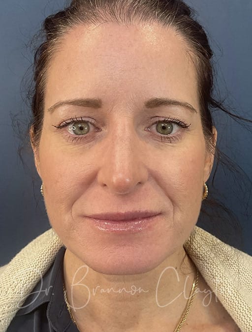 rhinoplasty-septoplasty-43524a-after-cnplastics