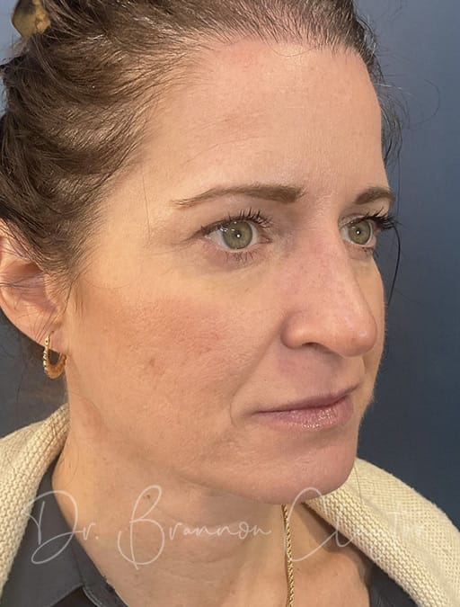 rhinoplasty-septoplasty-43524b-after-cnplastics