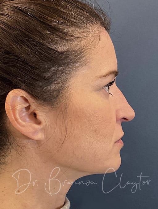 Rhinoplasty & Septoplasty