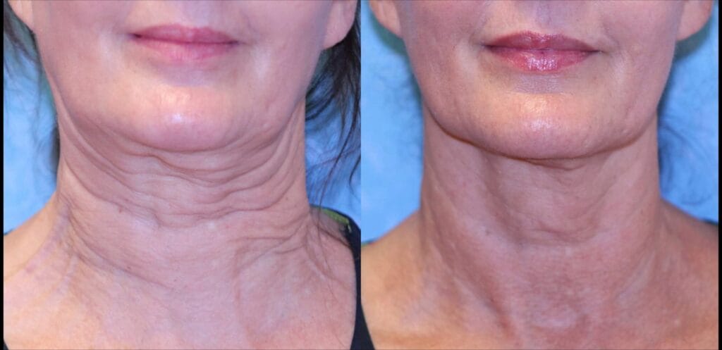 Before and after Sofwave skin tightening in the neck