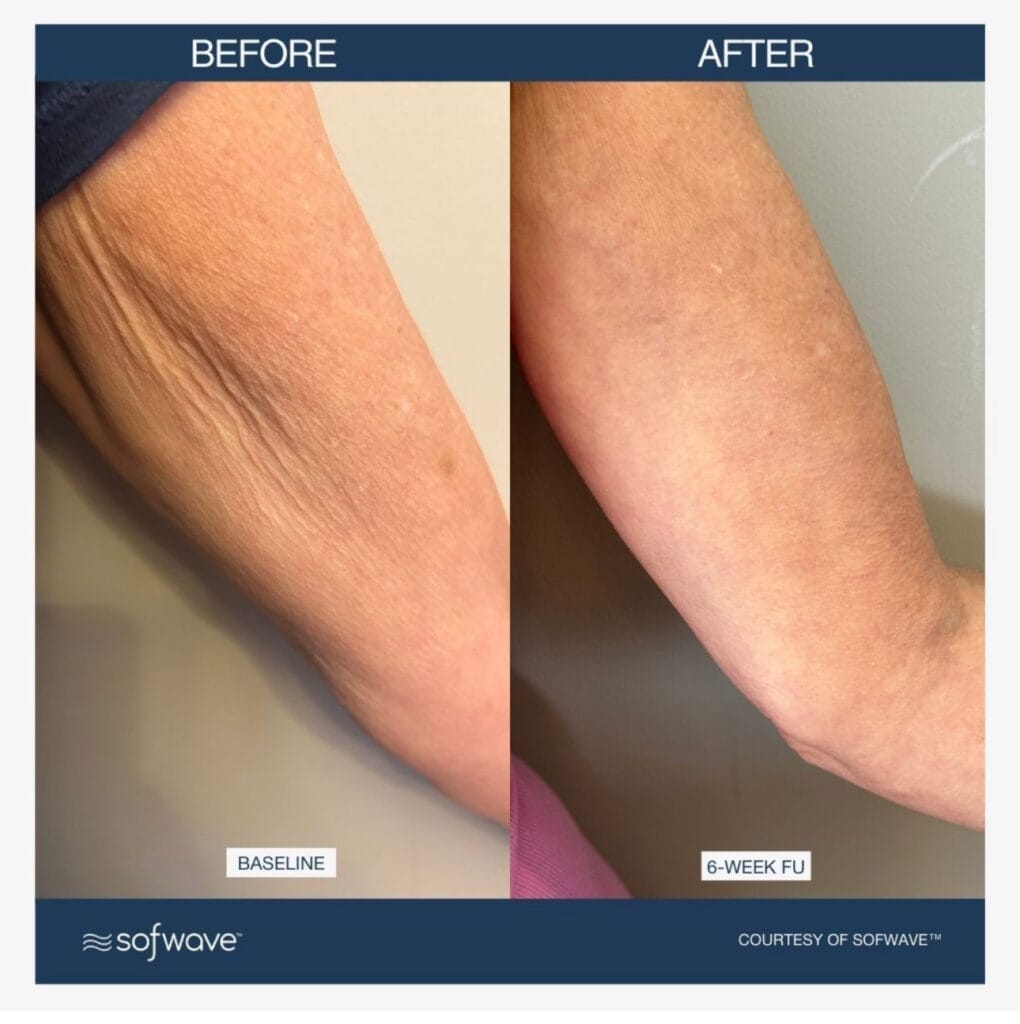 Sofwave before and after on the arms