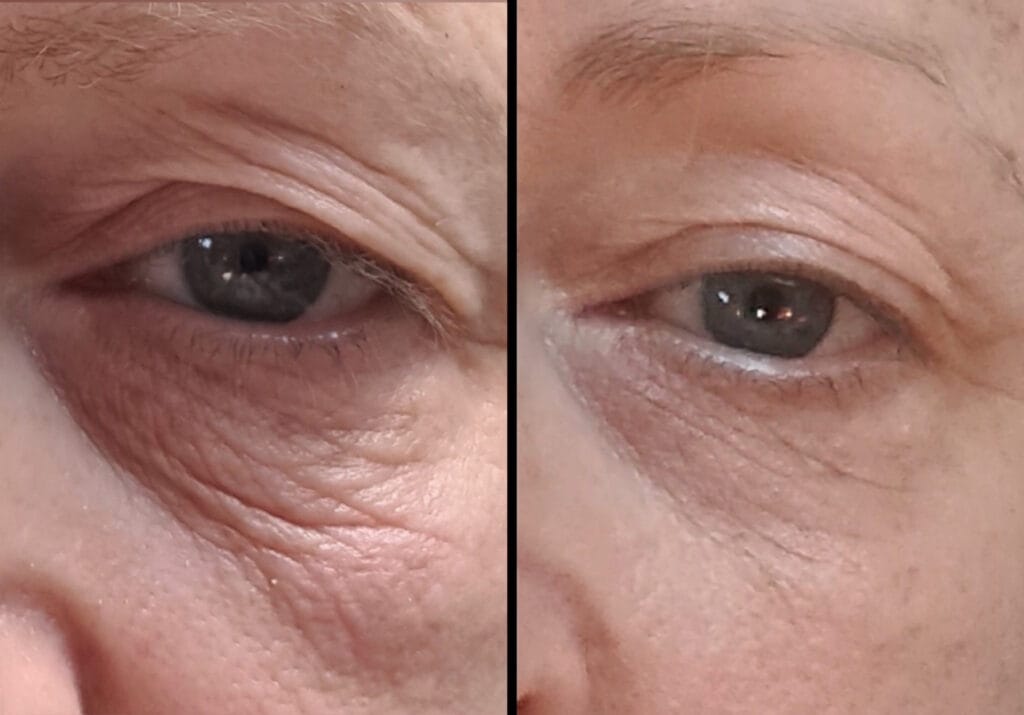 Sofwave before and after around the eyes