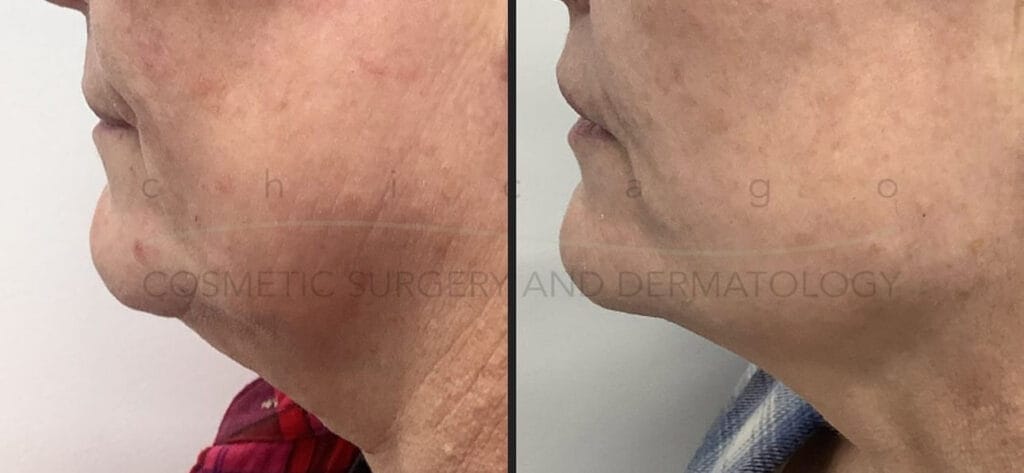 Sofwave before and after on the neck and chin