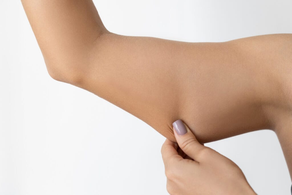 Woman pinching loose skin under arm after significant weight loss on GLP-1 injections