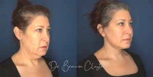 claytor-deep-plane-facelift-54yo-female-53872