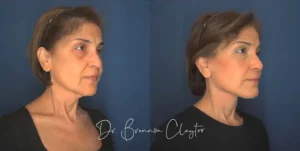 claytor-deep-plane-facelift-57-yo-female-53772
