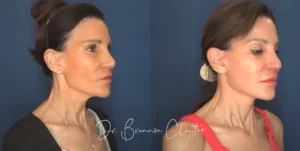 claytor-deep-plane-facelift-63yo-female-45646