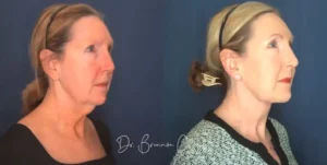 claytor-deep-plane-facelift-64yo-female-54031
