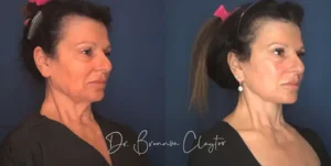 claytor-deep-plane-facelift-65yo-female-53538