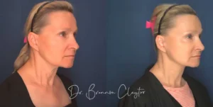 claytor-deep-plane-facelift-69yo-female-53886