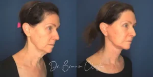 claytor-deep-plane-facelift-69yo-female-54458