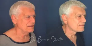 claytor-deep-plane-facelift-76yo-male-53006