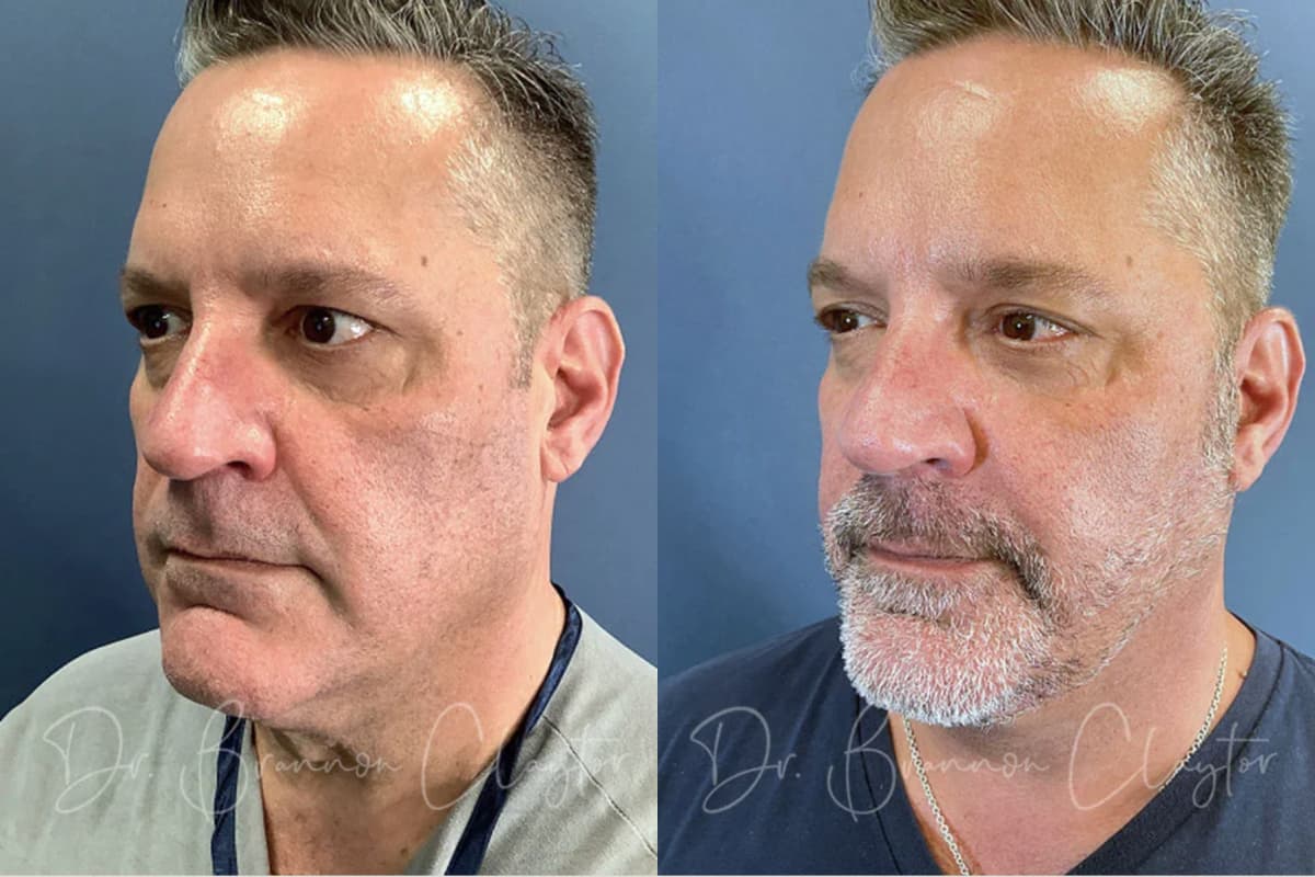 Before and after deep plane facelift for men at Claytor Plastic Surgery, showing a natural, masculine result with refined jawline
