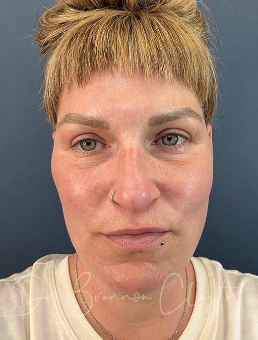 facelift-midface-endoscopic-5001a-after-cnplastics