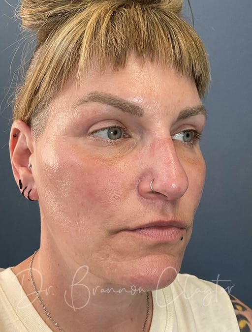 facelift-midface-endoscopic-5001b-after-cnplastics