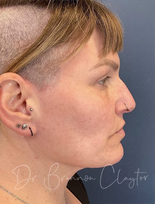 Facelift midface endoscopic