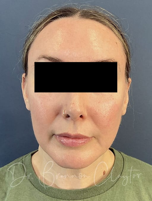 facelift-midface-endoscopic-5002a-after-cnplastics