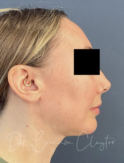 Facelift midface endoscopic