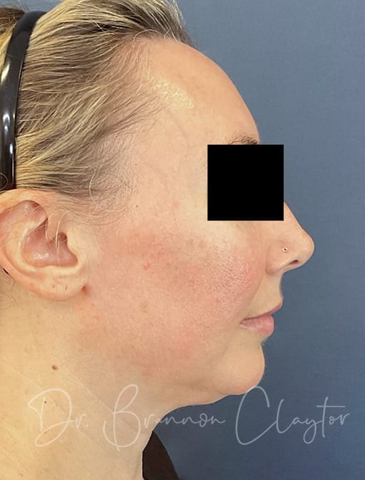 Facelift midface endoscopic