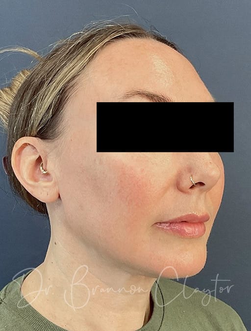 facelift-midface-endoscopic-5002cb-after-cnplastics