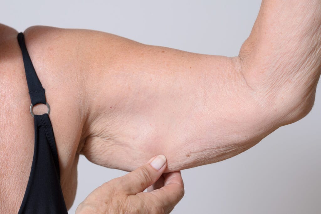Woman pinching excess skin on arm