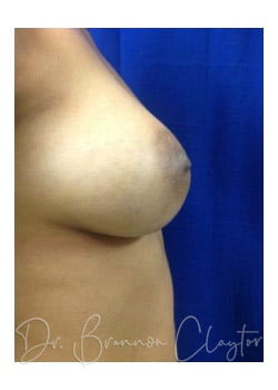 Breast Augmentation