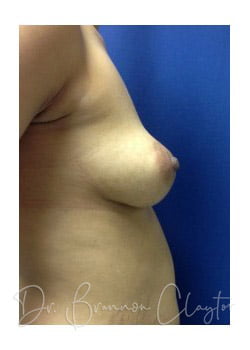 Breast Augmentation